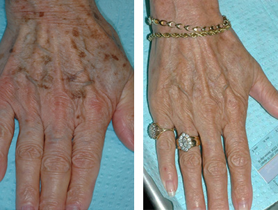pigmented lesions before and after